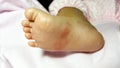 close-up newborn baby feet skin athleteÃ¢â¬â¢s foot psoriasis fungus, hong kong foot, foot disease